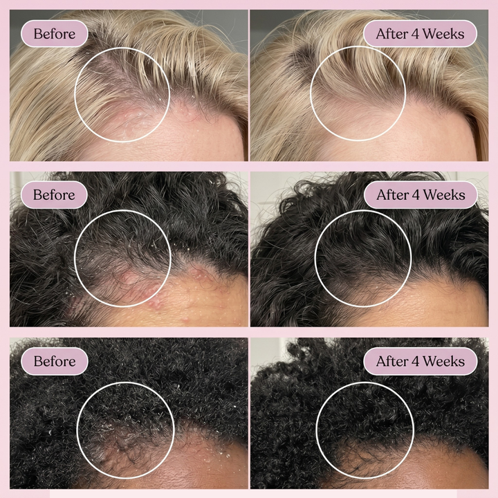 A 2x3 before-and-after collage showing hair growth results on three different hair types over 4 weeks. Each panel shows a close-up of the scalp with a white circle highlighting hair density improvement, labeled 'Before' and 'After 4 Weeks'.