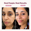 Before and after facial comparison of a woman, with the headline 'Real People. Real Results.